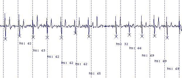 ecg